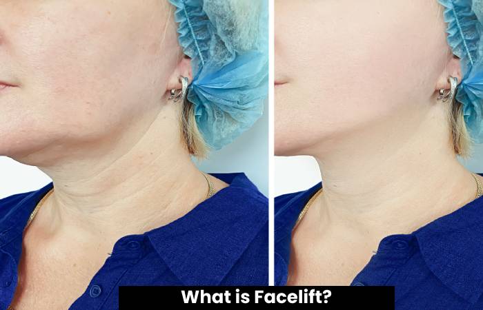 Facelift in Madrid, Improves the Signs of Aging on the Face (1)