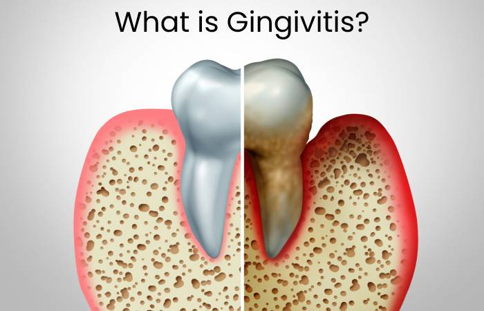 Gingivitis Treatments and Medications (1)