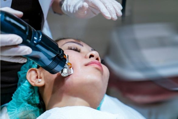 Halo Laser Treatment