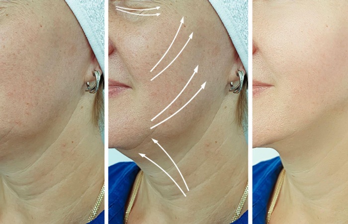 How Does Dimple Surgery Work_