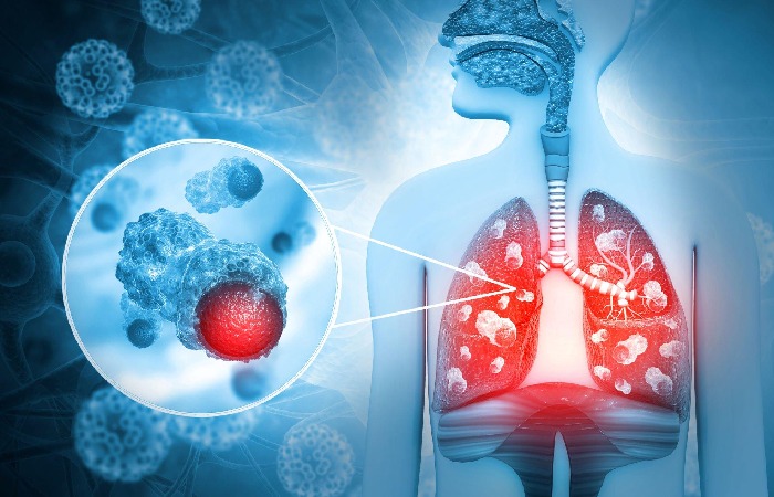 Tuberculosis