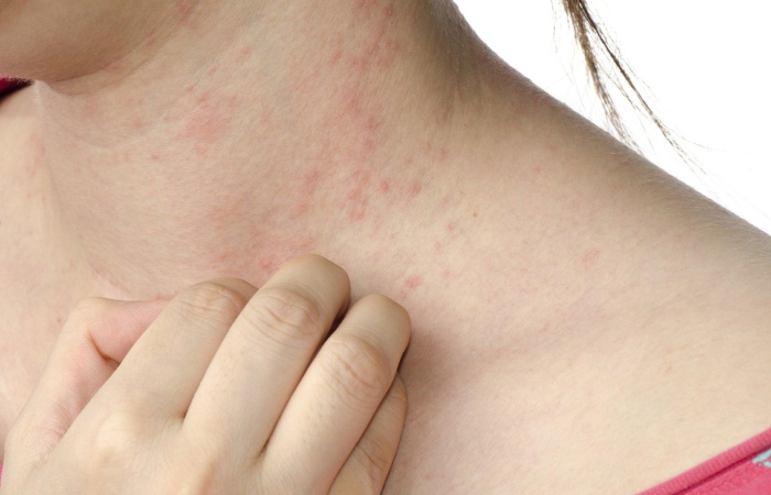 contact dermatitis