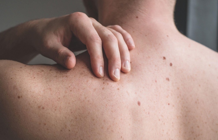 skin cancer 