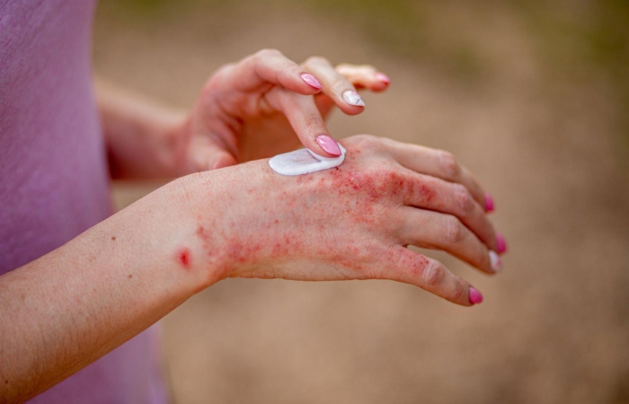 skin diseases 