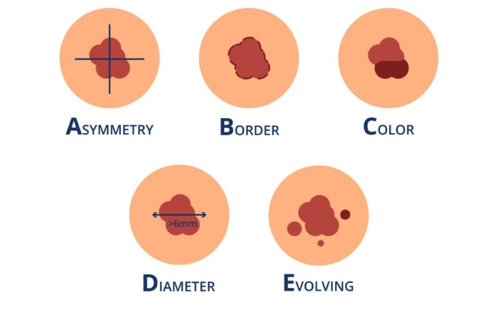 Skin Cancer Signs And Symptoms