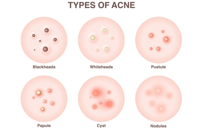 Types of Acne