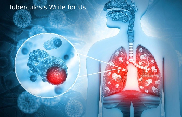 Tuberculosis Write for Us
