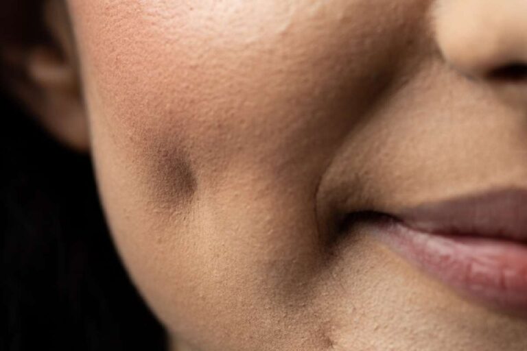 Dimple Surgery