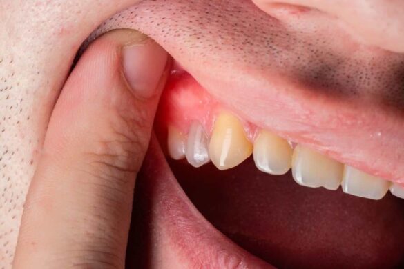 Gingivitis Treatments and Medications