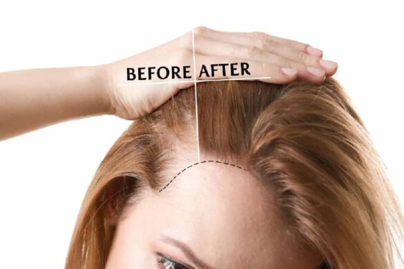 Female Pattern Baldness
